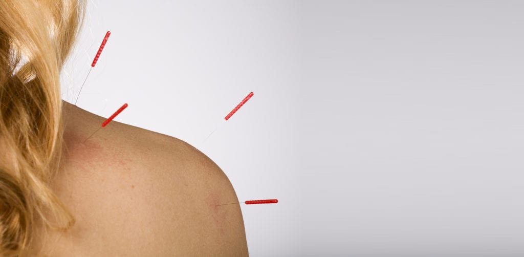 Acupuncture patient with acupuncture needles in shoulder - focus on furthest needles from camera